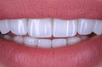 Що краще ставити коронки чи вініри?