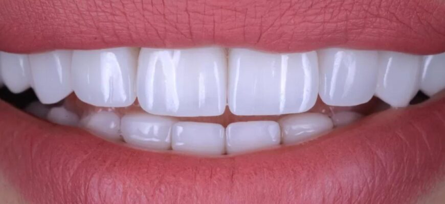 Що краще ставити коронки чи вініри?