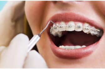 Чи можуть брекети швидко вирівняти зуби?
