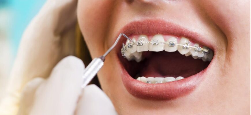 Чи можуть брекети швидко вирівняти зуби?
